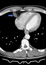 Öksürük ve hapşırık krizine girdi, hastanede çıkan sonucu görünce hayatının şokunu yaşadı