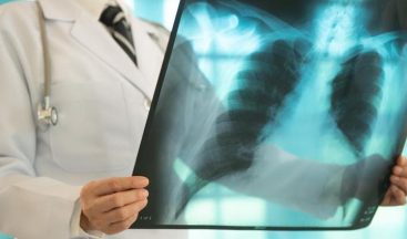 Erken tanı hayati önem taşıyor! Akciğer kanserinin belirtileri ne?